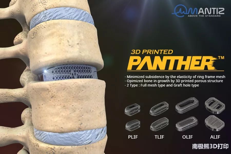 韩国Mantiz钛合金3D打印脊柱植入物，使用中国SLM金属3D打印机