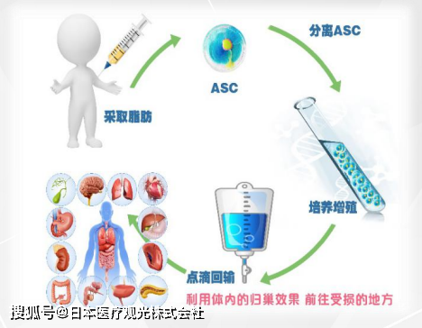 JMT-干细胞治疗糖尿病